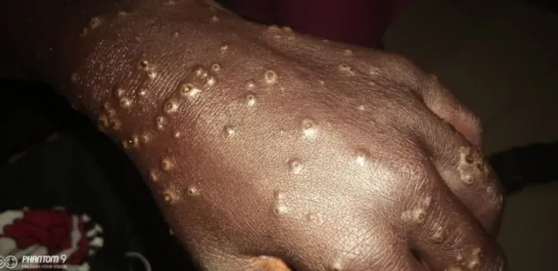 Etrange maladie pecheurs Thiaroye Sur Mer Canalactu